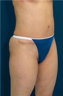 Tummy Tuck After Photo by Ricardo Rodriguez, MD; Lutherville-Timonium, MD - Case 27104