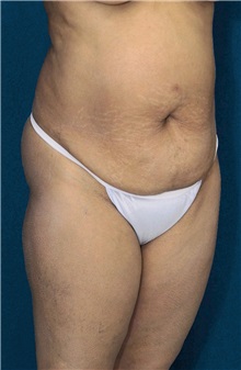 Tummy Tuck Before Photo by Ricardo Rodriguez, MD; Lutherville-Timonium, MD - Case 27104