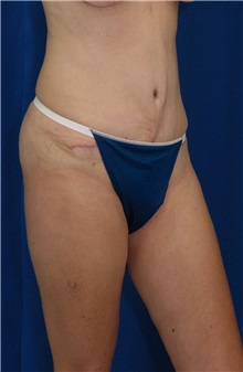 Tummy Tuck After Photo by Ricardo Rodriguez, MD; Lutherville-Timonium, MD - Case 27105