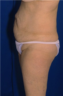 Tummy Tuck Before Photo by Ricardo Rodriguez, MD; Lutherville-Timonium, MD - Case 27105