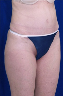Tummy Tuck After Photo by Ricardo Rodriguez, MD; Lutherville-Timonium, MD - Case 27106