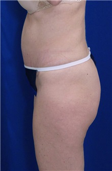 Tummy Tuck After Photo by Ricardo Rodriguez, MD; Lutherville-Timonium, MD - Case 27106