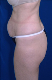 Tummy Tuck Before Photo by Ricardo Rodriguez, MD; Lutherville-Timonium, MD - Case 27106