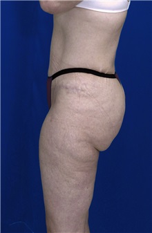 Tummy Tuck After Photo by Ricardo Rodriguez, MD; Lutherville-Timonium, MD - Case 27107