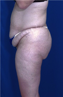 Tummy Tuck Before Photo by Ricardo Rodriguez, MD; Lutherville-Timonium, MD - Case 27107