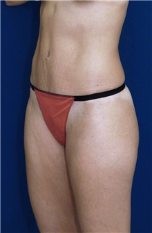 Tummy Tuck After Photo by Ricardo Rodriguez, MD; Lutherville-Timonium, MD - Case 27108