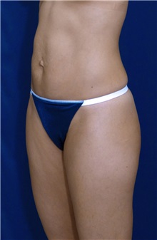 Tummy Tuck Before Photo by Ricardo Rodriguez, MD; Lutherville-Timonium, MD - Case 27108