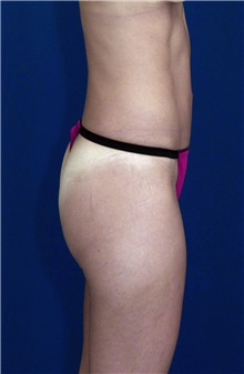 Tummy Tuck After Photo by Ricardo Rodriguez, MD; Lutherville-Timonium, MD - Case 27108