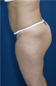 Tummy Tuck After Photo by Ricardo Rodriguez, MD; Lutherville-Timonium, MD - Case 27109