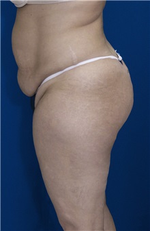 Tummy Tuck Before Photo by Ricardo Rodriguez, MD; Lutherville-Timonium, MD - Case 27109