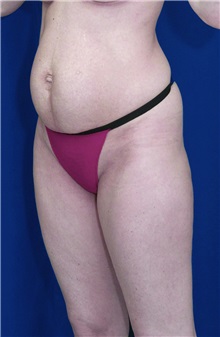 Tummy Tuck Before Photo by Ricardo Rodriguez, MD; Lutherville-Timonium, MD - Case 27110