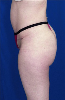 Tummy Tuck After Photo by Ricardo Rodriguez, MD; Lutherville-Timonium, MD - Case 27110