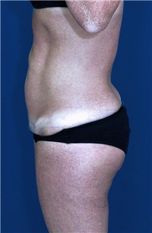 Tummy Tuck After Photo by Ricardo Rodriguez, MD; Lutherville-Timonium, MD - Case 27111