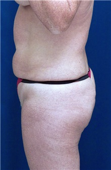 Tummy Tuck Before Photo by Ricardo Rodriguez, MD; Lutherville-Timonium, MD - Case 27111
