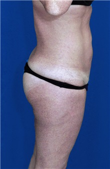 Tummy Tuck After Photo by Ricardo Rodriguez, MD; Lutherville-Timonium, MD - Case 27111