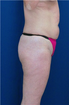Tummy Tuck Before Photo by Ricardo Rodriguez, MD; Lutherville-Timonium, MD - Case 27111