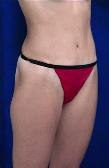 Tummy Tuck After Photo by Ricardo Rodriguez, MD; Lutherville-Timonium, MD - Case 27112