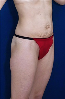 Tummy Tuck Before Photo by Ricardo Rodriguez, MD; Lutherville-Timonium, MD - Case 27112