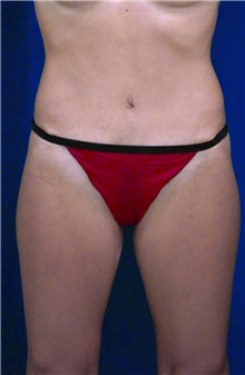 Tummy Tuck After Photo by Ricardo Rodriguez, MD; Lutherville-Timonium, MD - Case 27112