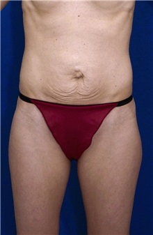 Tummy Tuck Before Photo by Ricardo Rodriguez, MD; Lutherville-Timonium, MD - Case 27112