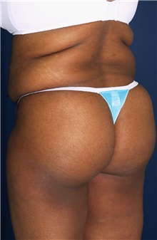 Tummy Tuck Before Photo by Ricardo Rodriguez, MD; Lutherville-Timonium, MD - Case 27145