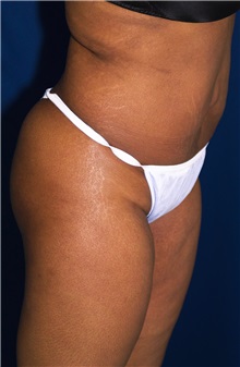Tummy Tuck After Photo by Ricardo Rodriguez, MD; Lutherville-Timonium, MD - Case 27145