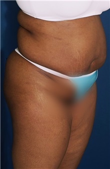 Tummy Tuck Before Photo by Ricardo Rodriguez, MD; Lutherville-Timonium, MD - Case 27145