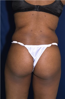 Tummy Tuck After Photo by Ricardo Rodriguez, MD; Lutherville-Timonium, MD - Case 27145