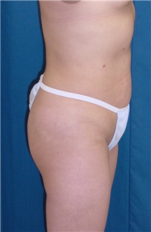 Tummy Tuck Before Photo by Ricardo Rodriguez, MD; Lutherville-Timonium, MD - Case 27146