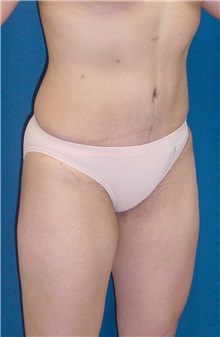 Tummy Tuck After Photo by Ricardo Rodriguez, MD; Lutherville-Timonium, MD - Case 27146
