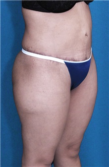 Tummy Tuck After Photo by Ricardo Rodriguez, MD; Lutherville-Timonium, MD - Case 27148