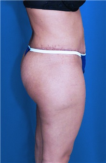 Tummy Tuck After Photo by Ricardo Rodriguez, MD; Lutherville-Timonium, MD - Case 27148