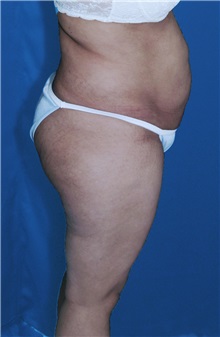 Tummy Tuck Before Photo by Ricardo Rodriguez, MD; Lutherville-Timonium, MD - Case 27148