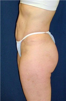 Tummy Tuck After Photo by Ricardo Rodriguez, MD; Lutherville-Timonium, MD - Case 27149