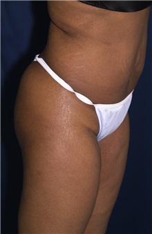 Buttock Implants After Photo by Ricardo Rodriguez, MD; Lutherville-Timonium, MD - Case 27150
