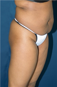 Buttock Implants Before Photo by Ricardo Rodriguez, MD; Lutherville-Timonium, MD - Case 27150