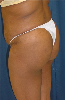 Buttock Implants After Photo by Ricardo Rodriguez, MD; Lutherville-Timonium, MD - Case 27151