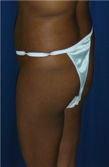 Buttock Implants Before Photo by Ricardo Rodriguez, MD; Lutherville-Timonium, MD - Case 27151