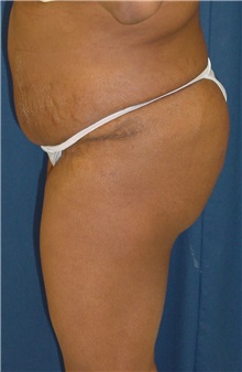 Buttock Implants After Photo by Ricardo Rodriguez, MD; Lutherville-Timonium, MD - Case 27151