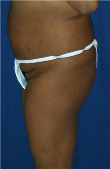 Buttock Implants Before Photo by Ricardo Rodriguez, MD; Lutherville-Timonium, MD - Case 27151