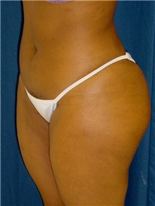 Buttock Implants After Photo by Ricardo Rodriguez, MD; Lutherville-Timonium, MD - Case 27156
