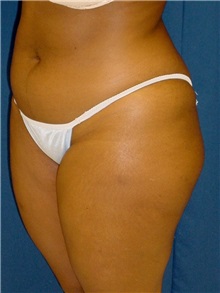Buttock Implants Before Photo by Ricardo Rodriguez, MD; Lutherville-Timonium, MD - Case 27156