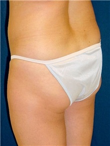 Buttock Implants Before Photo by Ricardo Rodriguez, MD; Lutherville-Timonium, MD - Case 27157