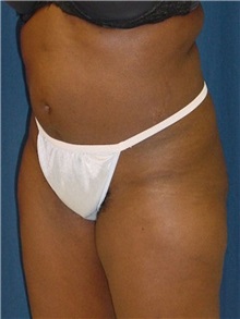 Buttock Implants Before Photo by Ricardo Rodriguez, MD; Lutherville-Timonium, MD - Case 27158