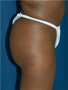 Buttock Implants After Photo by Ricardo Rodriguez, MD; Lutherville-Timonium, MD - Case 27158