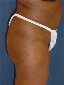 Buttock Implants Before Photo by Ricardo Rodriguez, MD; Lutherville-Timonium, MD - Case 27158