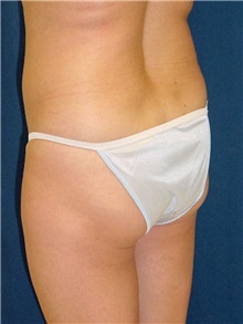 Buttock Implants Before Photo by Ricardo Rodriguez, MD; Lutherville-Timonium, MD - Case 27159
