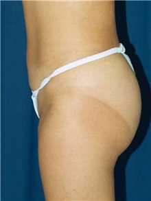 Buttock Implants After Photo by Ricardo Rodriguez, MD; Lutherville-Timonium, MD - Case 27159