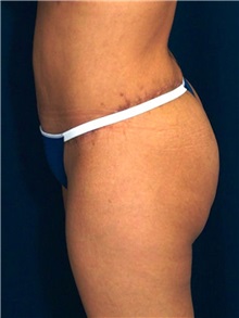 Buttock Implants After Photo by Ricardo Rodriguez, MD; Lutherville-Timonium, MD - Case 27160
