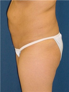 Buttock Implants Before Photo by Ricardo Rodriguez, MD; Lutherville-Timonium, MD - Case 27160
